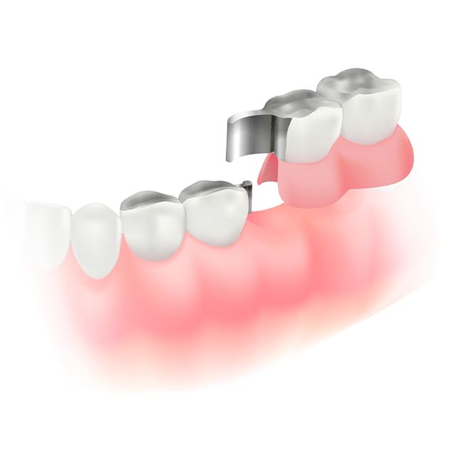 アタッチメントデンチャー