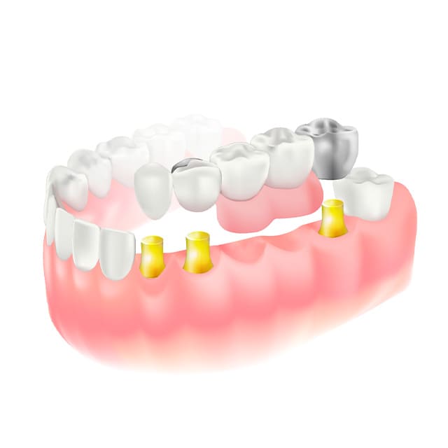 コーヌスデンチャー