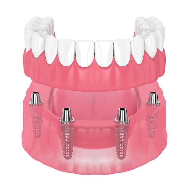 インプラントオーバーデンチャー