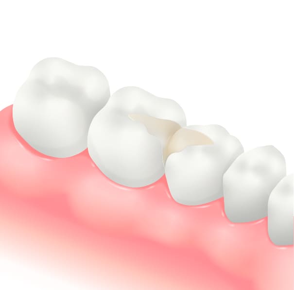 CAD/CAMレジンインレー