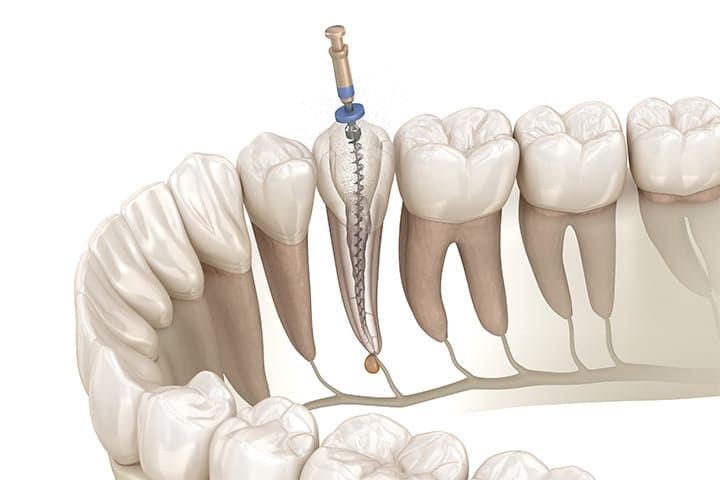 歯の根っこ治療(根管治療)
